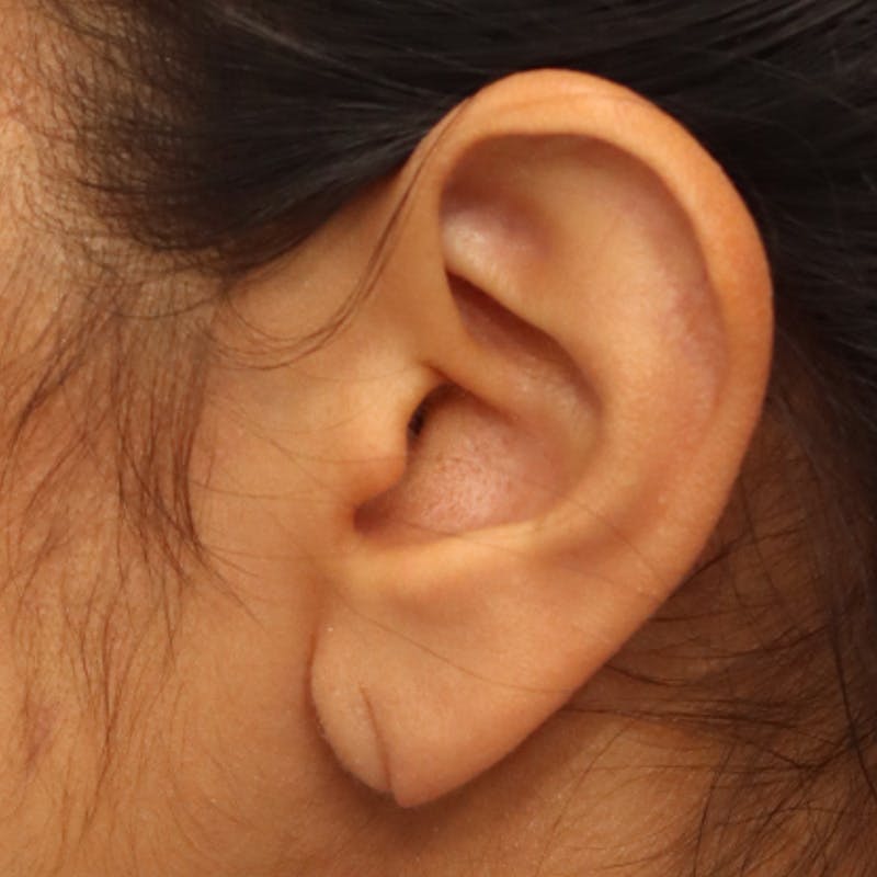 Earlobe Repair Before & After Gallery - Patient 123862317 - Image 1