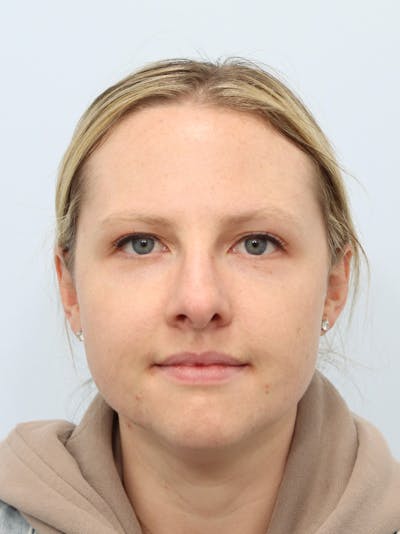 Neck Liposuction Before & After Gallery - Patient 143651366 - Image 1