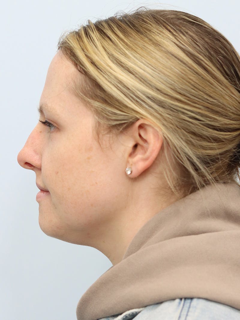 Neck Liposuction Before & After Gallery - Patient 143651366 - Image 5