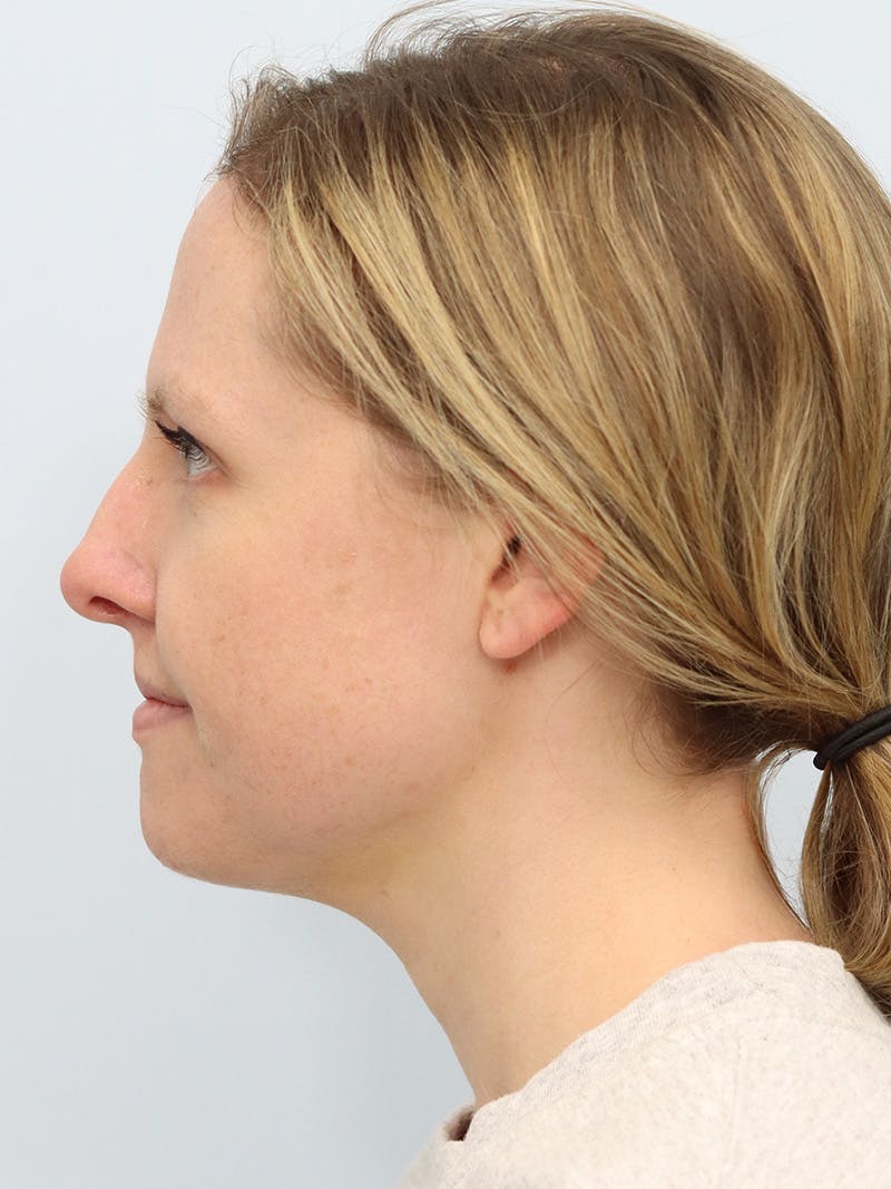 Neck Liposuction Before & After Gallery - Patient 143651366 - Image 6