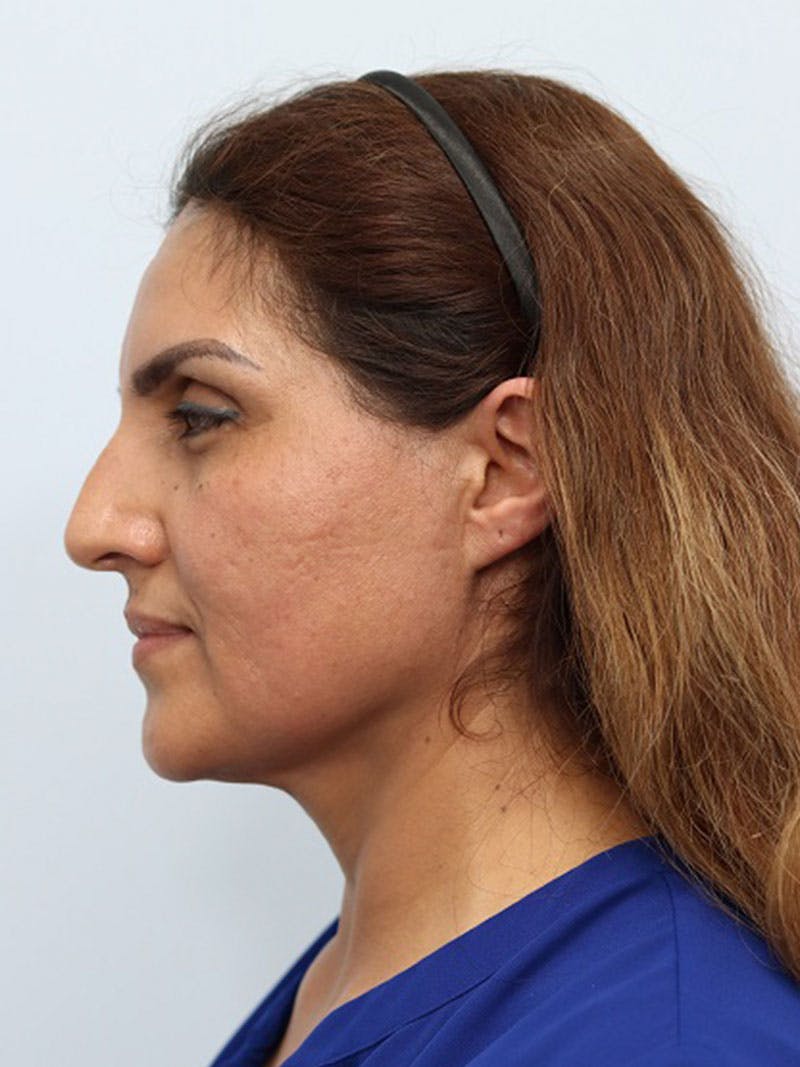 Microneedling Before & After Gallery - Patient 143744244 - Image 5