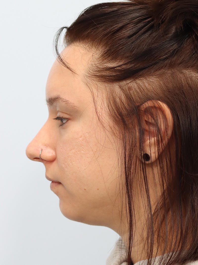 PDO Thread Lift Before & After Gallery - Patient 144687376 - Image 5