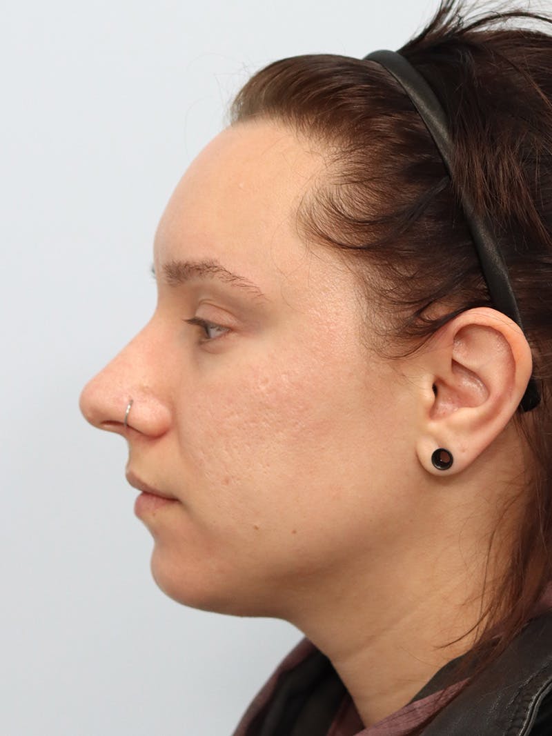 PDO Thread Lift Before & After Gallery - Patient 144687376 - Image 6