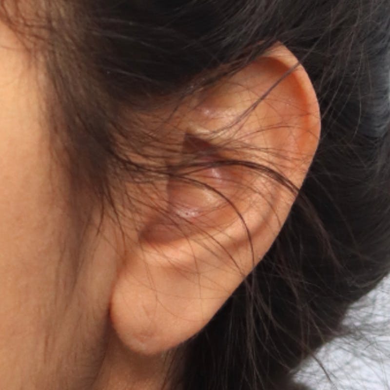 Earlobe Repair Before & After Gallery - Patient 123862317 - Image 2