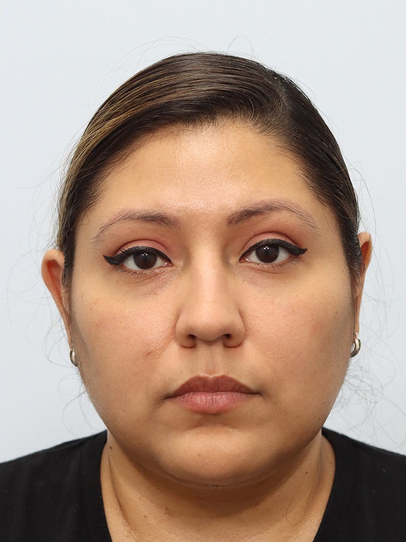 Neck Liposuction Before & After Gallery - Patient 147644157 - Image 6