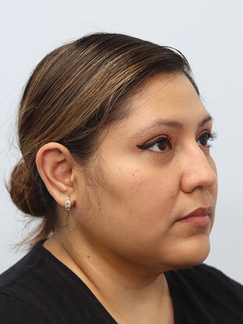 Neck Liposuction Before & After Gallery - Patient 147644157 - Image 8