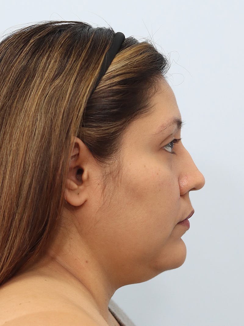 Neck Liposuction Before & After Gallery - Patient 147644157 - Image 9