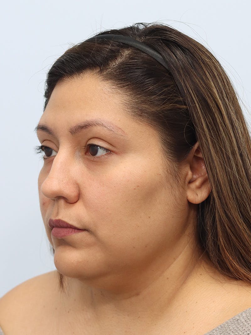 Neck Liposuction Before & After Gallery - Patient 147644157 - Image 1