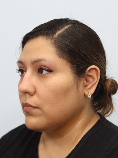 Neck Liposuction Before & After Gallery - Patient 147644157 - Image 2