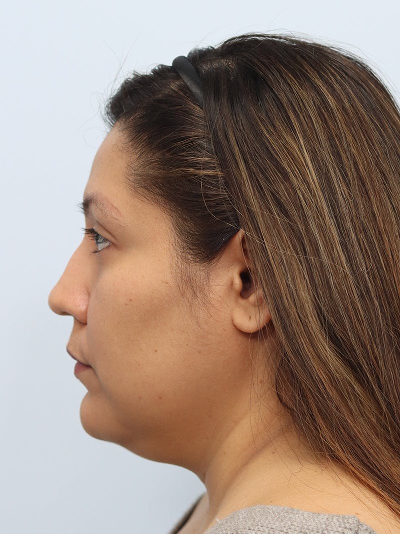 Neck Liposuction Before & After Gallery - Patient 147644157 - Image 3