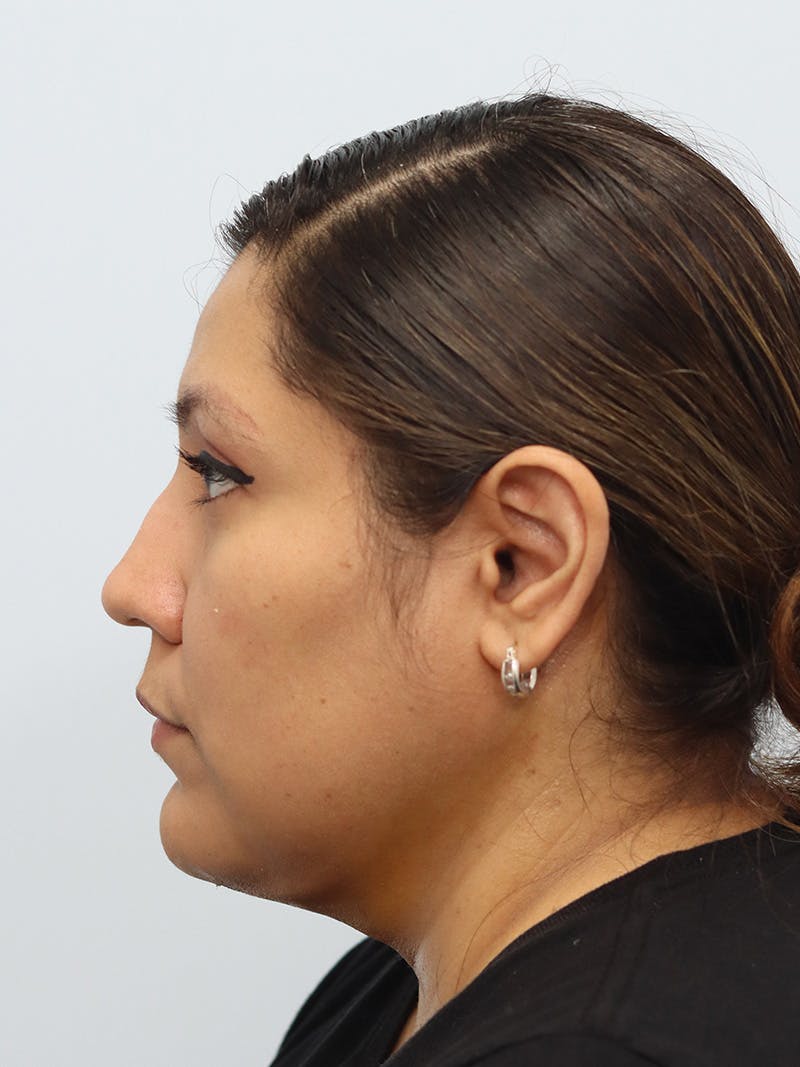 Neck Liposuction Before & After Gallery - Patient 147644157 - Image 4