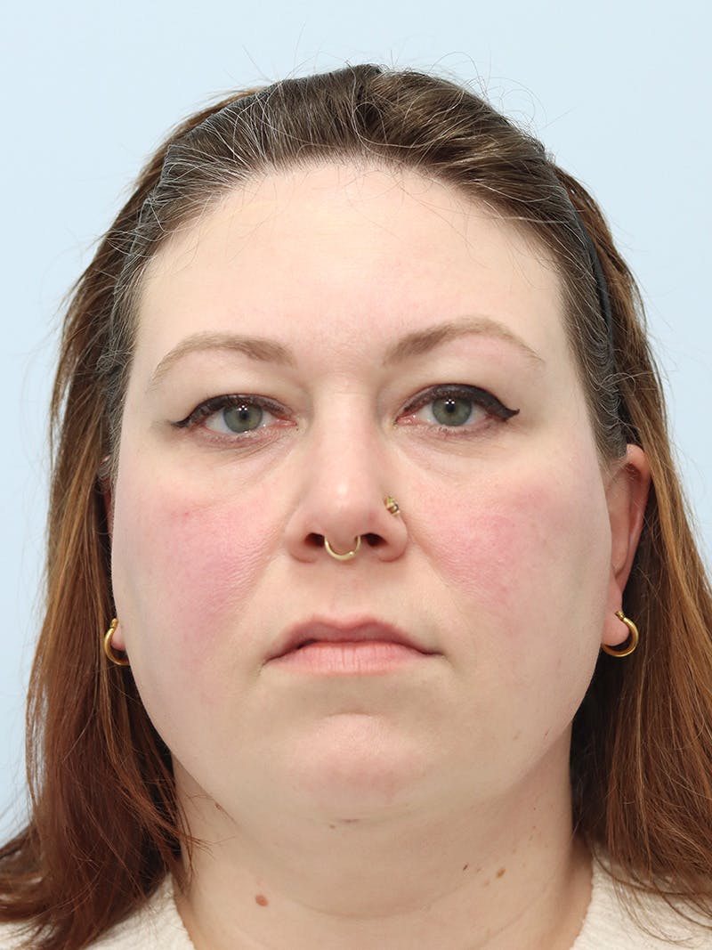 Facelift Before & After Gallery - Patient 147666071 - Image 2