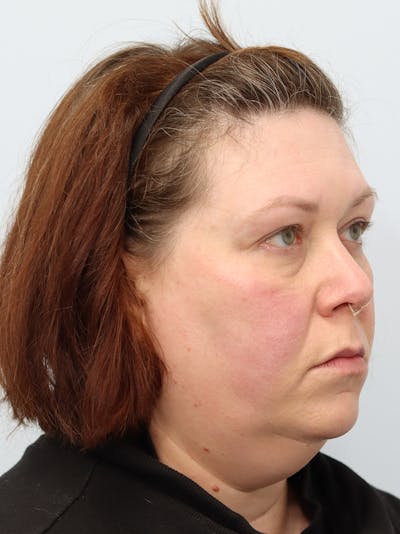 Neck Lift Before & After Gallery - Patient 147666072 - Image 1