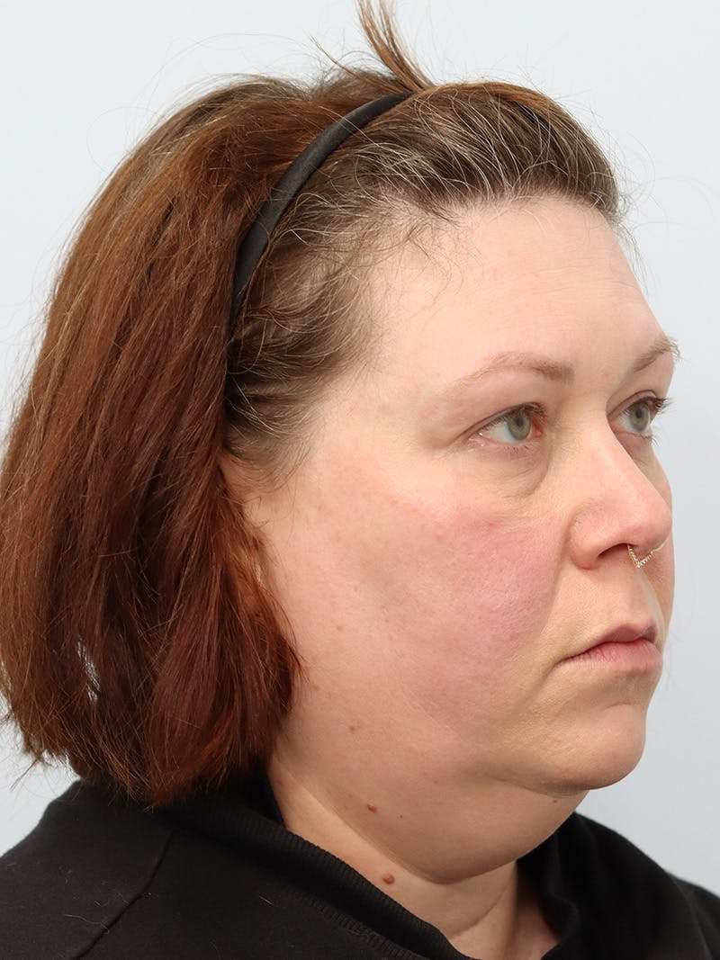 Neck Liposuction Before & After Gallery - Patient 147666073 - Image 5