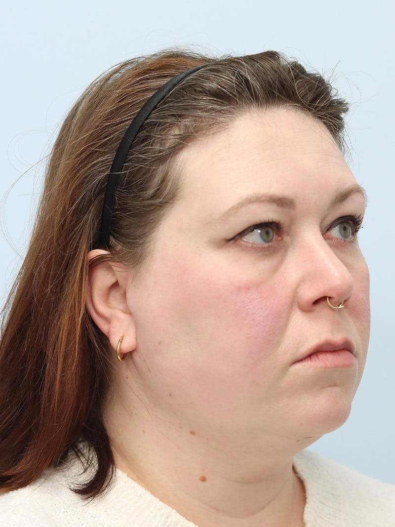 Facelift Before & After Gallery - Patient 147666071 - Image 4