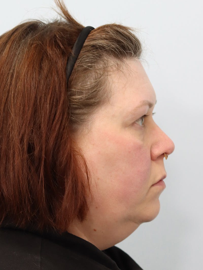Neck Lift Before & After Gallery - Patient 147666072 - Image 5