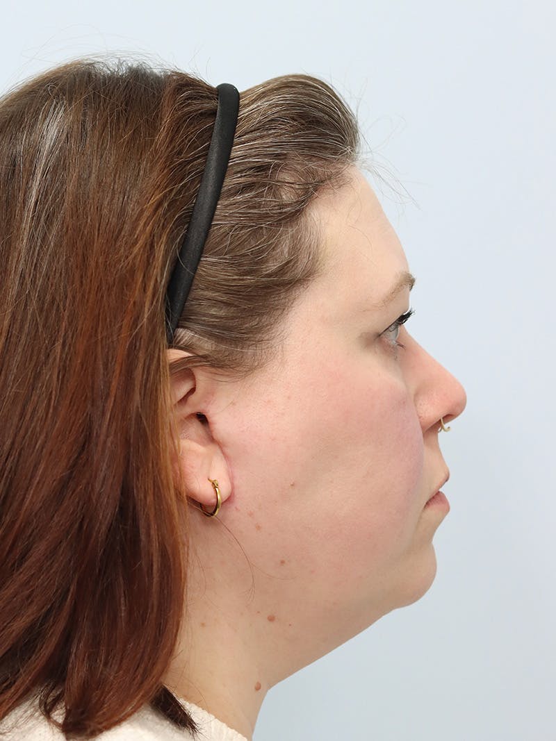 Neck Liposuction Before & After Gallery - Patient 147666073 - Image 8