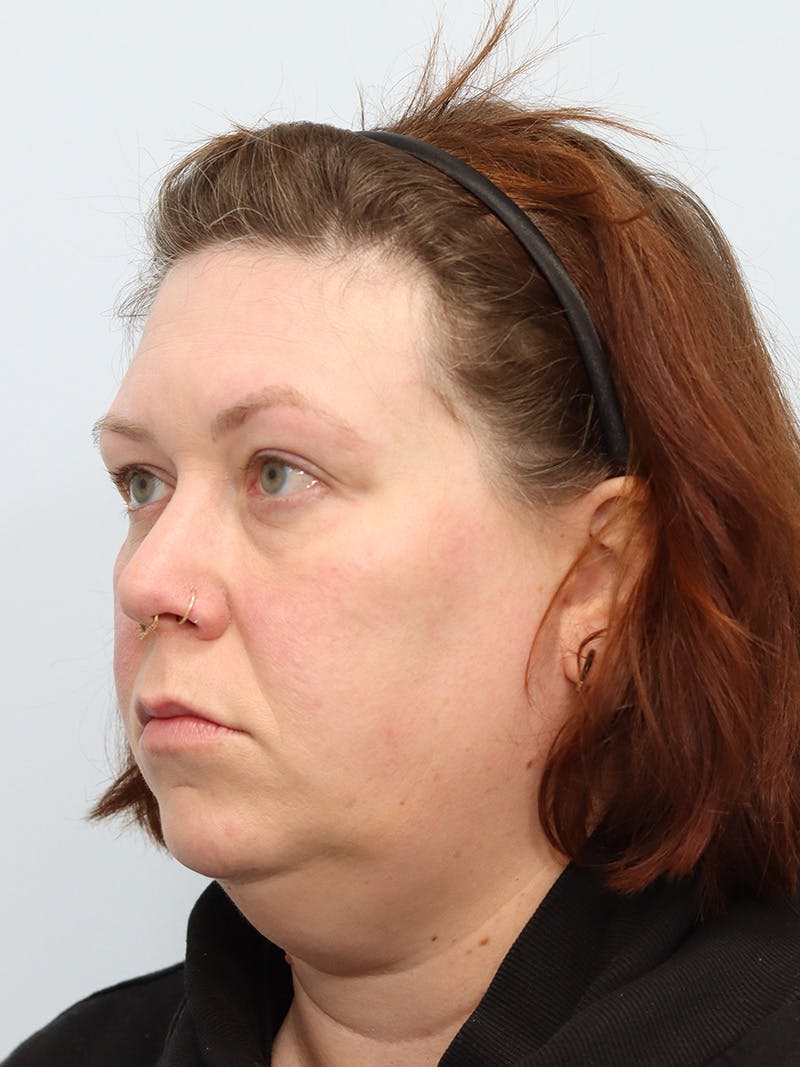 Neck Liposuction Before & After Gallery - Patient 147666073 - Image 1