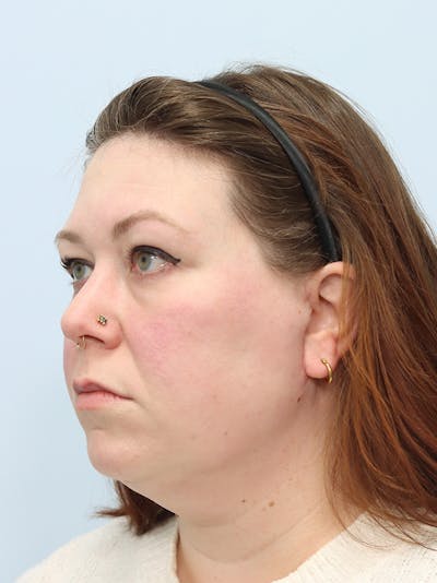 Neck Liposuction Before & After Gallery - Patient 147666073 - Image 2