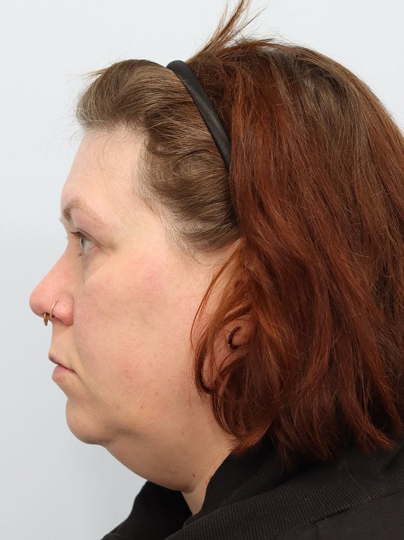 Facelift Before & After Gallery - Patient 147666071 - Image 9