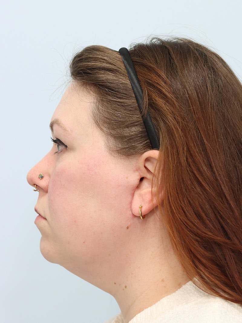 Neck Lift Before & After Gallery - Patient 147666072 - Image 10