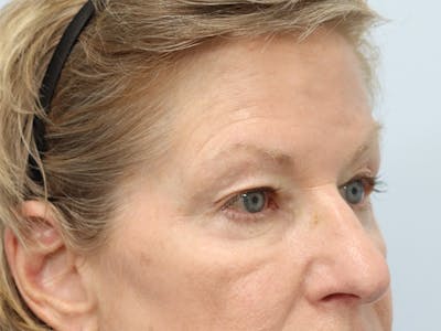 Blepharoplasty Before & After Gallery - Patient 148518996 - Image 1
