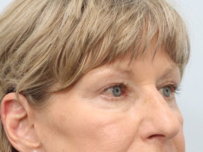 Blepharoplasty Before & After Gallery - Patient 148518996 - Image 2