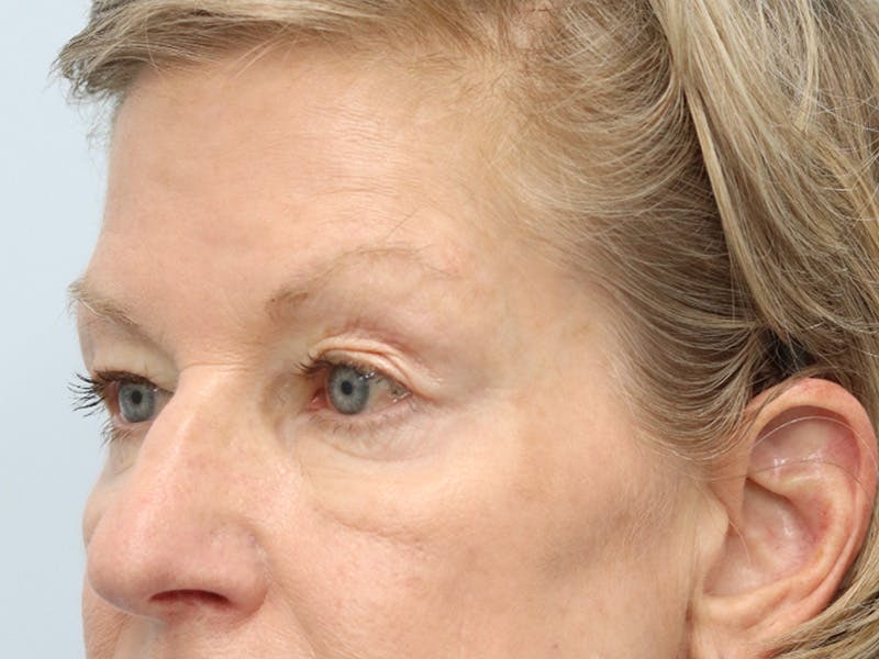 Blepharoplasty Before & After Gallery - Patient 148518996 - Image 3