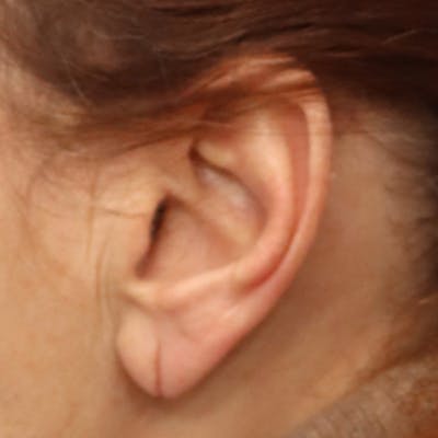 Earlobe Repair Surgery, Chicago, IL