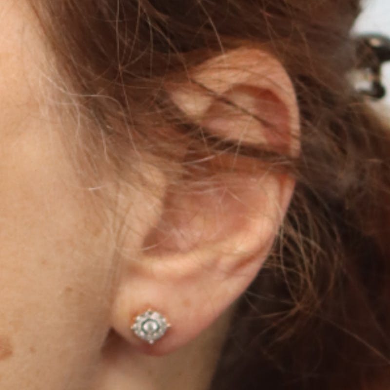 Earlobe Repair Before & After Gallery - Patient 147616895 - Image 4