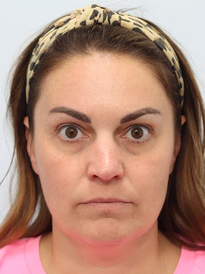 Botox® & Neurotoxins Before & After Gallery - Patient 149260279 - Image 2