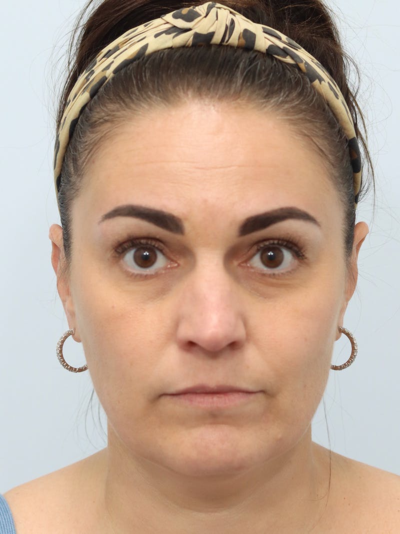 Botox® & Neurotoxins Before & After Gallery - Patient 149260279 - Image 3