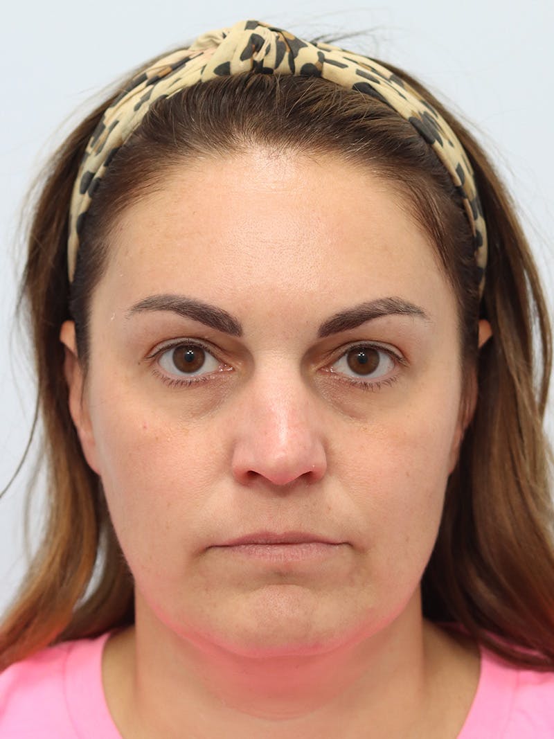Botox® & Neurotoxins Before & After Gallery - Patient 149260279 - Image 4