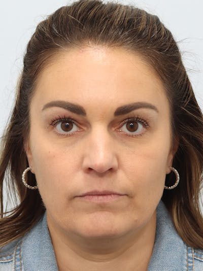 Fillers Before & After Gallery - Patient 149260281 - Image 2