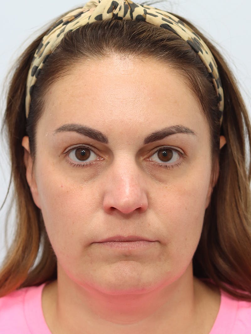 Fillers Before & After Gallery - Patient 149260281 - Image 1