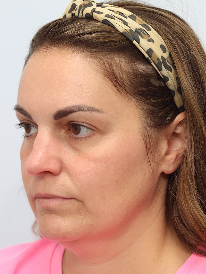 Fillers Before & After Gallery - Patient 149260281 - Image 3