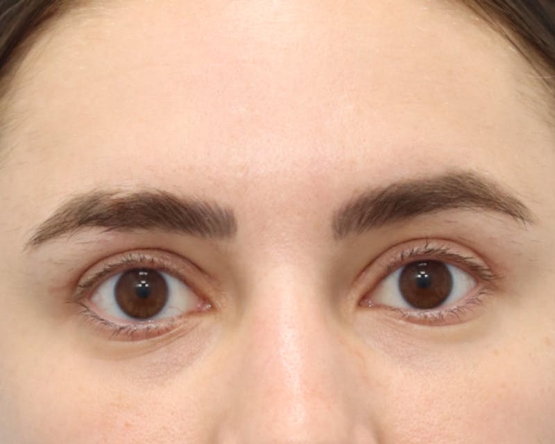 Blepharoplasty Before & After Gallery - Patient 168556210 - Image 4