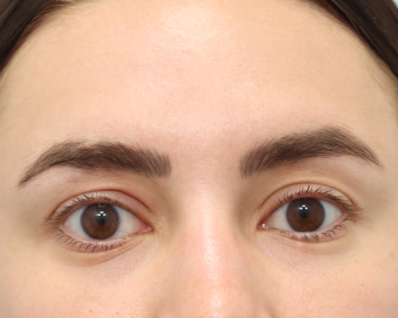 Blepharoplasty Before & After Gallery - Patient 168556210 - Image 3