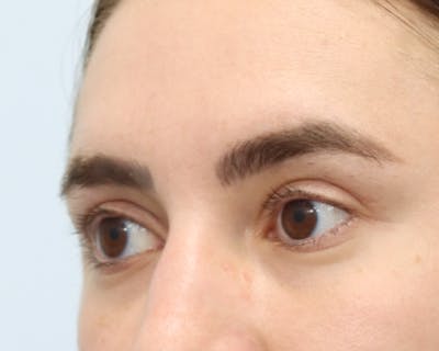 Blepharoplasty Before & After Gallery - Patient 168556210 - Image 2