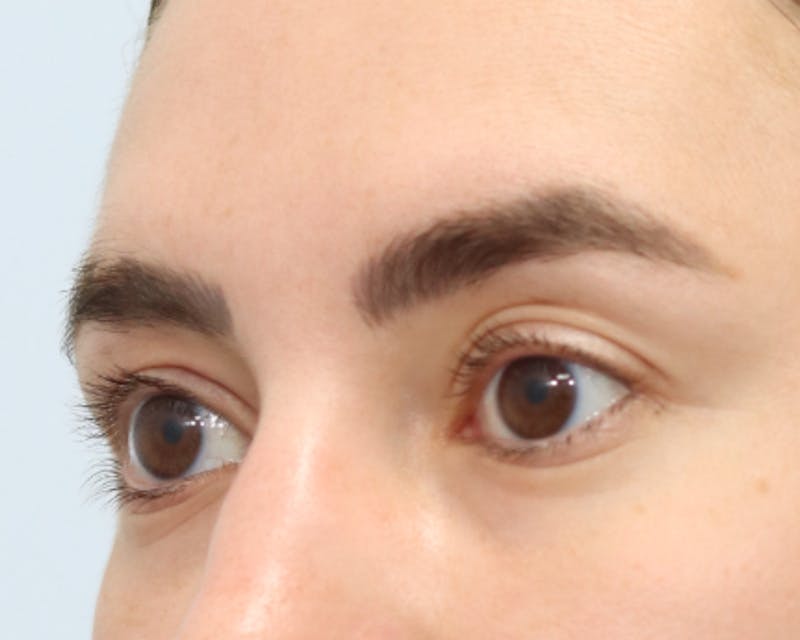 Blepharoplasty Before & After Gallery - Patient 168556210 - Image 1