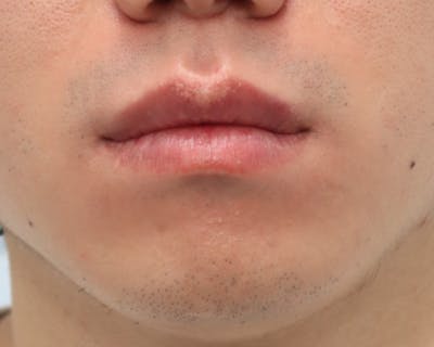 Laser Skin Treatment Before & After Gallery - Patient 177615389 - Image 1