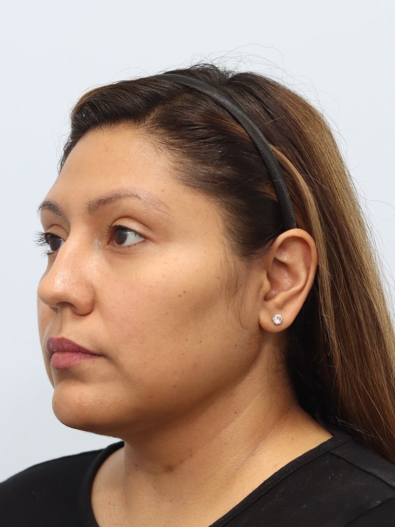 Neck Liposuction Before & After Gallery - Patient 147644157 - Image 2