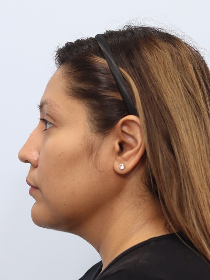 Neck Liposuction Before & After Gallery - Patient 147644157 - Image 4
