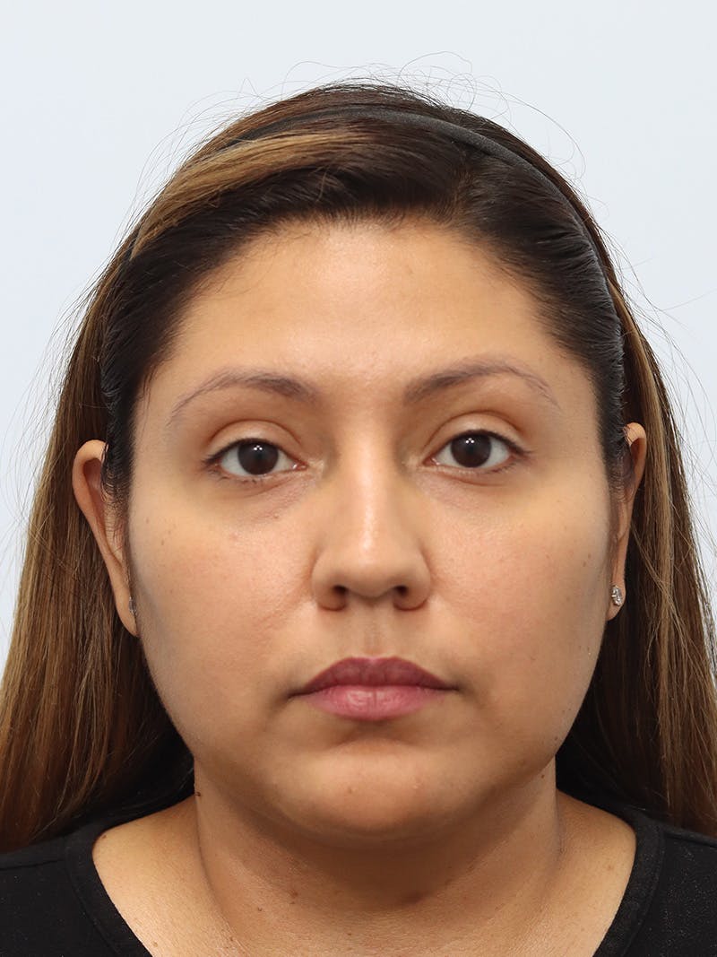 Neck Liposuction Before & After Gallery - Patient 147644157 - Image 6