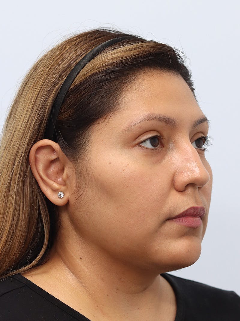 Neck Liposuction Before & After Gallery - Patient 147644157 - Image 8
