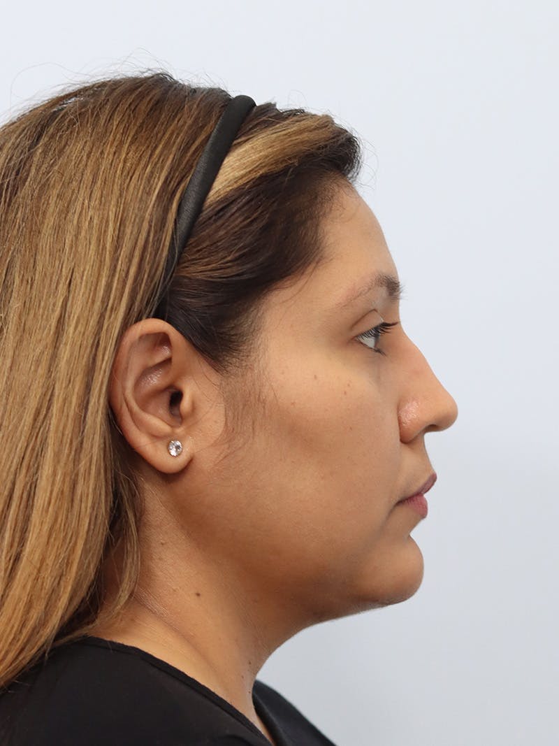 Neck Liposuction Before & After Gallery - Patient 147644157 - Image 10