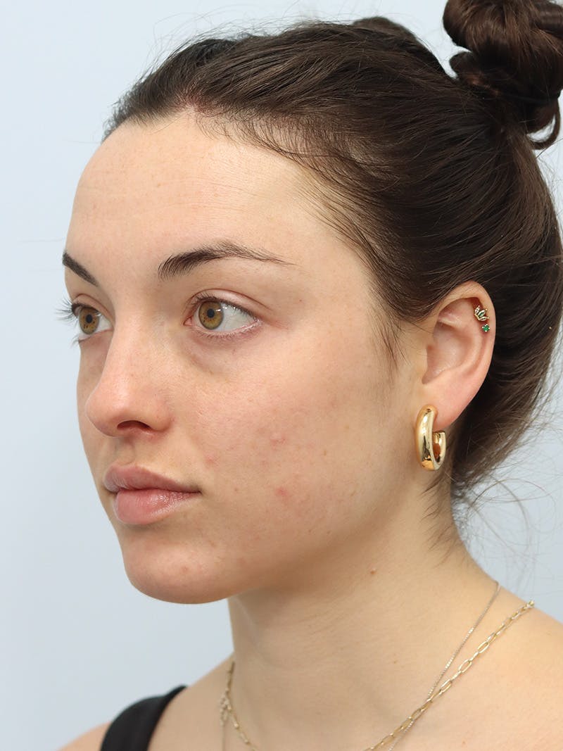 Buccal Fat Removal Before & After Gallery - Patient 188708359 - Image 7