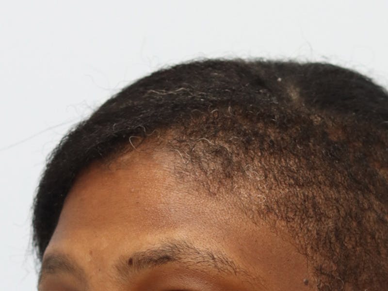 Reconstructive Before & After Gallery - Patient 188708374 - Image 4