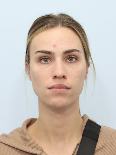 Facial Fat Transfer Before & After Gallery - Patient 425818 - Image 1