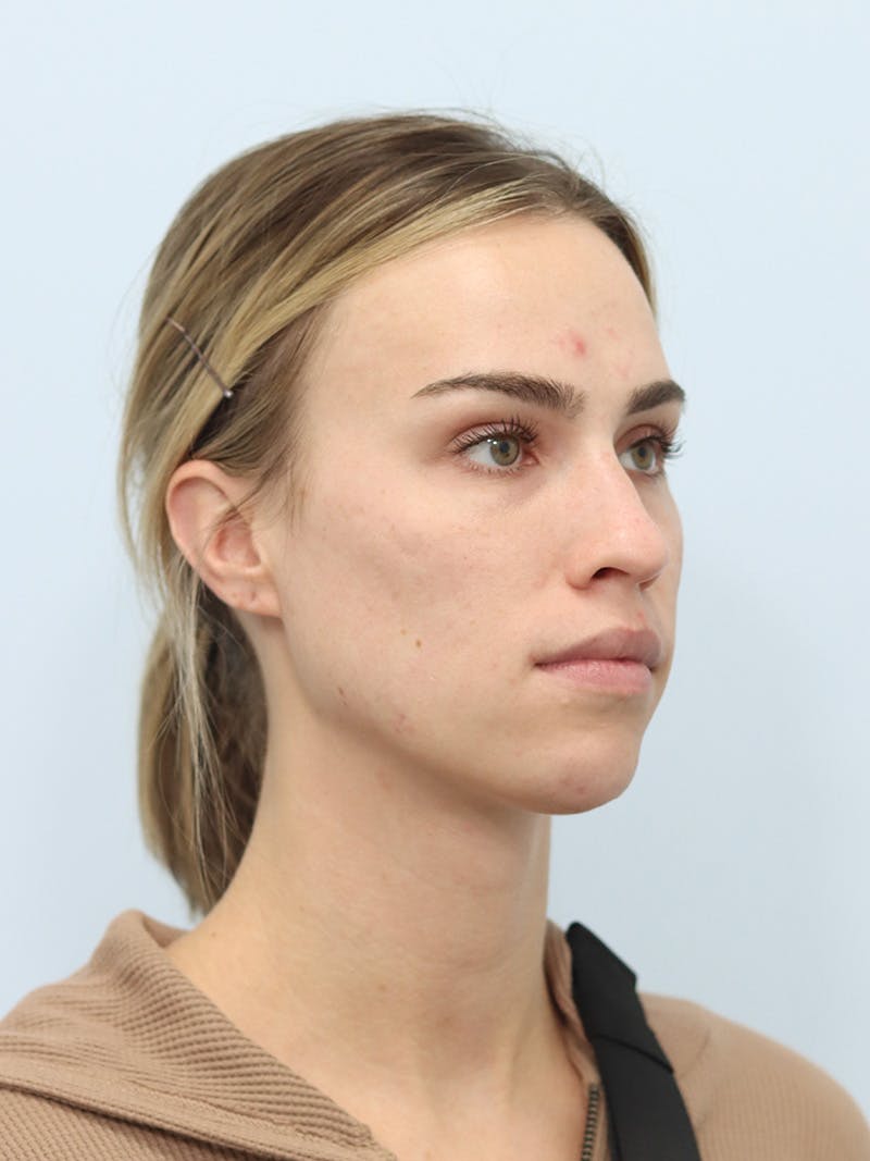 Facial Fat Transfer Before & After Gallery - Patient 425818 - Image 3